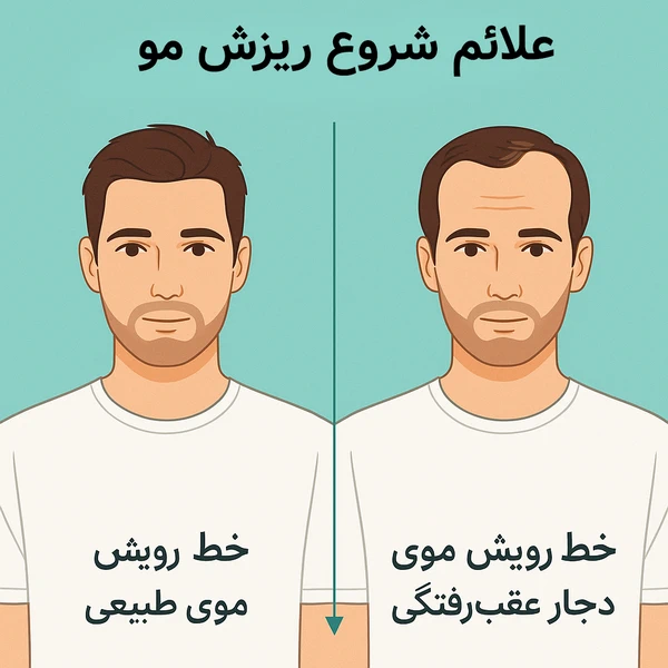 مقایسه خط رویش موی طبیعی و عقب‌رفته در ریزش مو